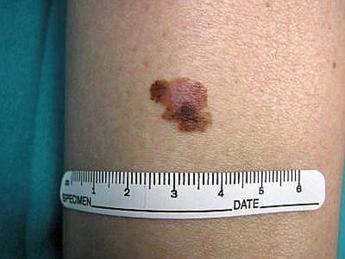 Tumori, contro melanoma il virus dell’herpes modificato funziona: lo studio