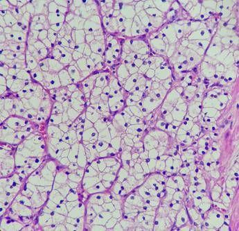 Studio, Tki e immunoterapia più efficace di sunitinib in carcinoma a cellule renali